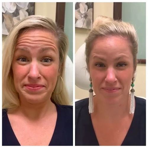 Customer photo review of BUGFB™ Korean Serum（Limited Time Discount 🔥 Last Day）