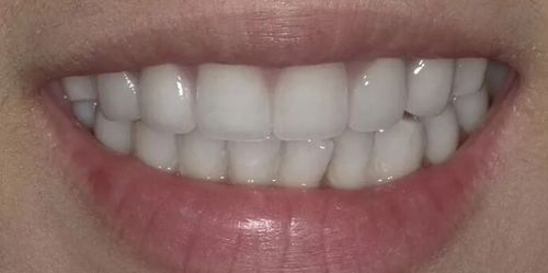 Customer photo review of Farbkorrektur - Strips