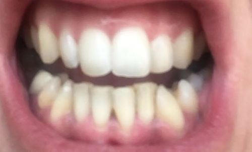 Customer photo review of Farbkorrektur - Strips