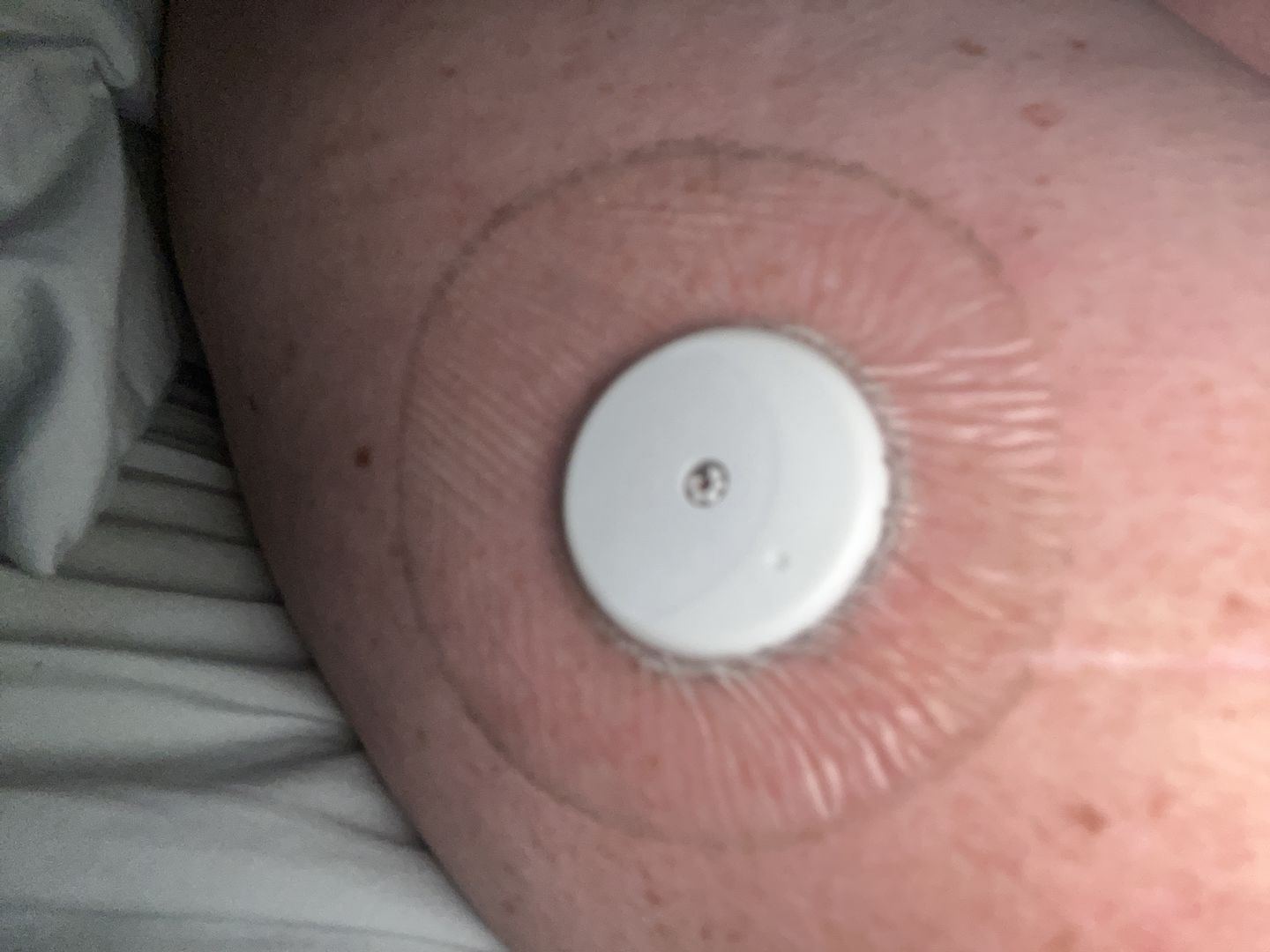 Customer photo review of Skin Grip Original - Freestyle Libre Adhesive Patches