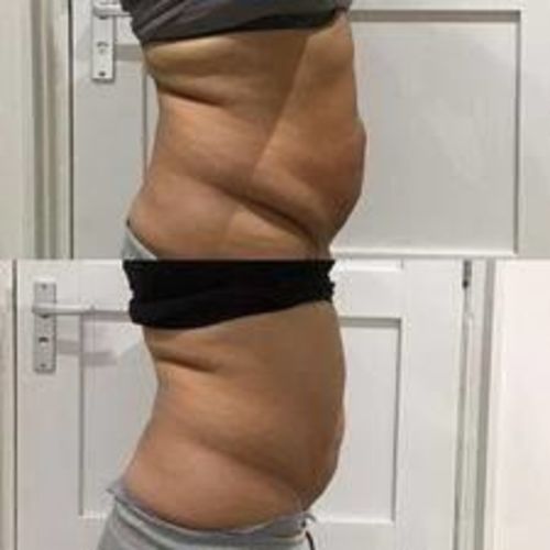 Customer photo review of Lymphatic Drainage Slimming Earrings（Limited Time Discount 🔥 Last Day）
