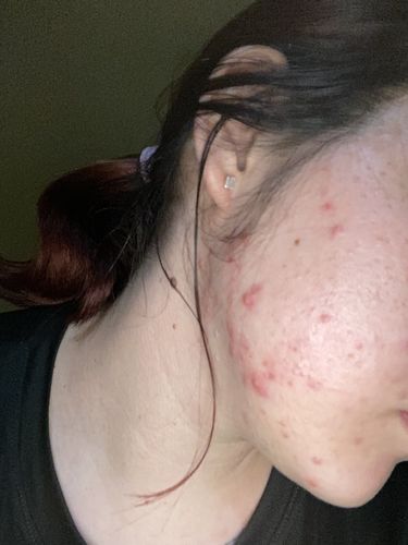 Customer photo review of Kit anti acné