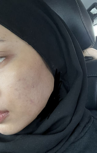 Customer photo review of Acne Rescue Kit