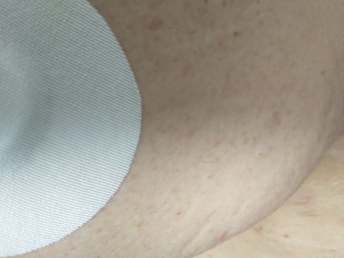 Customer photo review of Skin Grip Original - Freestyle Libre Adhesive Patches