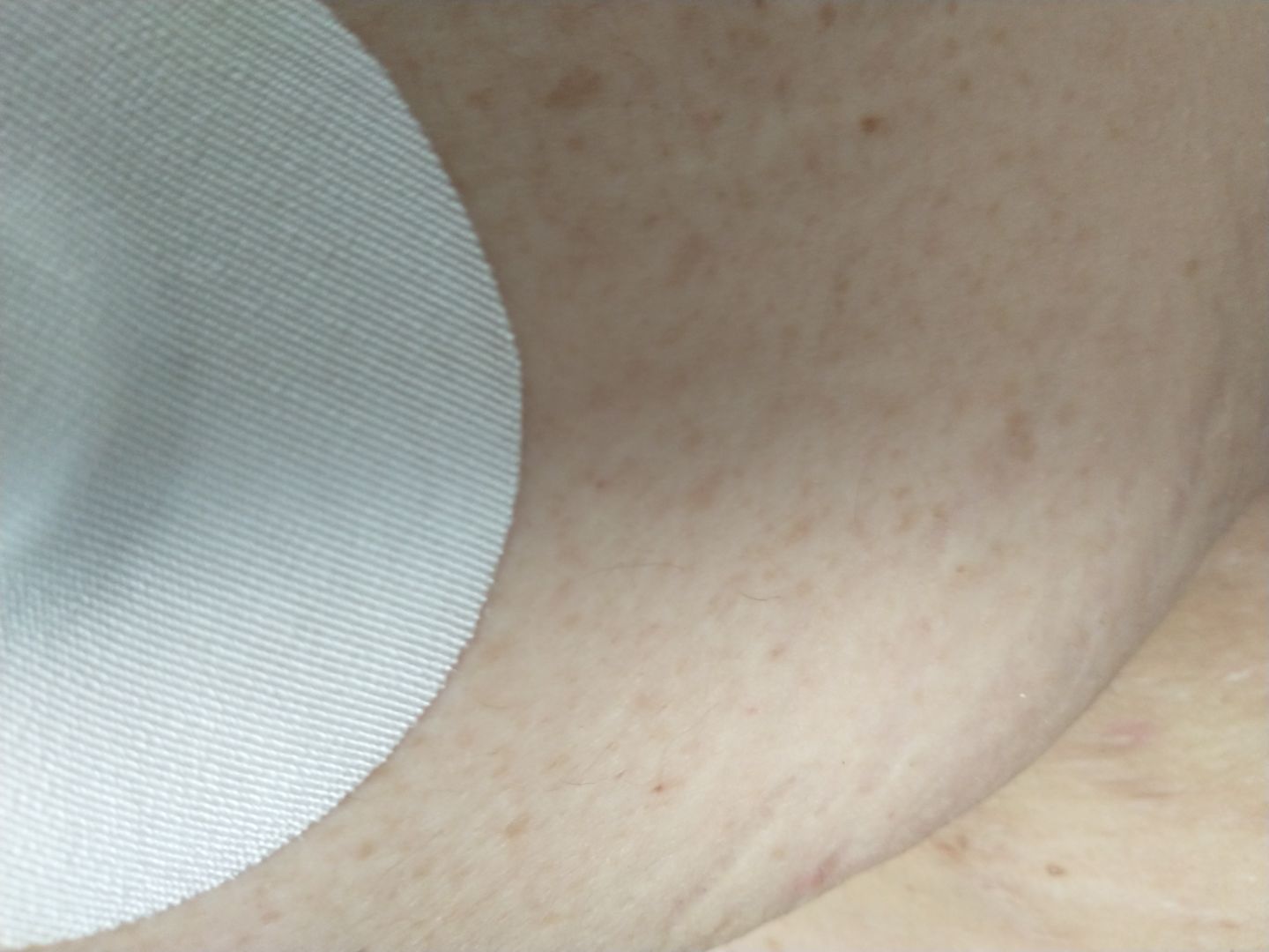 Customer photo review of Skin Grip Original - Freestyle Libre Adhesive Patches
