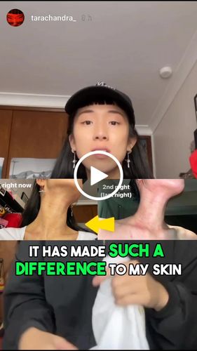 Customer video review of Eczema Scratch Mitten