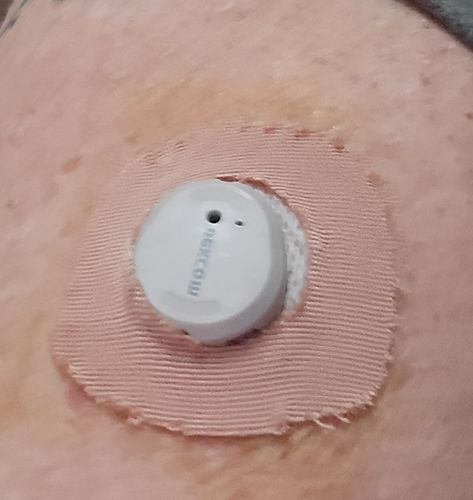 Customer photo review of Skin Grip Original - Dexcom G7 Adhesive Patches (With Hole)