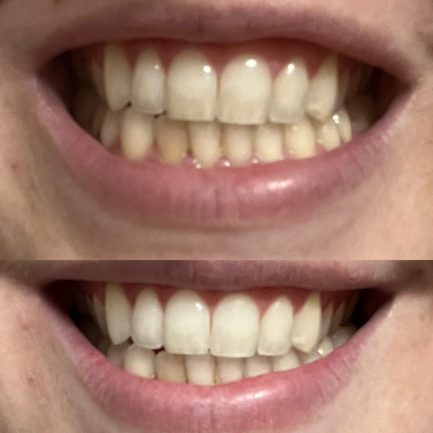 Customer photo review of Bandes Blanchissantes PAP (sans peroxyde)