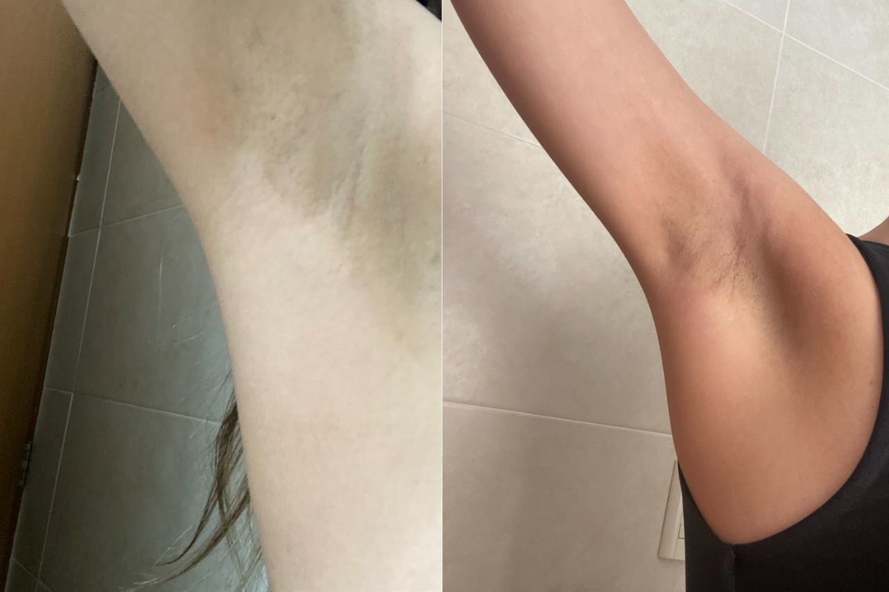Customer photo review of Kit de axilas mágico (aclarante + tarro) con envío gratis mx
