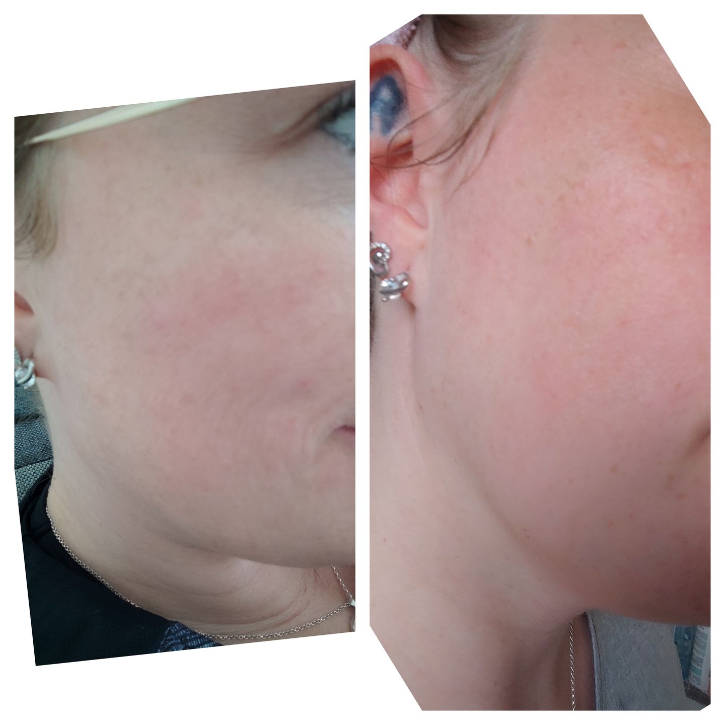 Customer photo review of Acide Hyaluronique - 1 mois