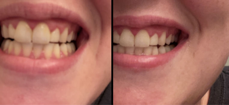 Customer photo review of Teeth Whitening Foam