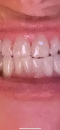 Customer photo review of bedrō Whitening