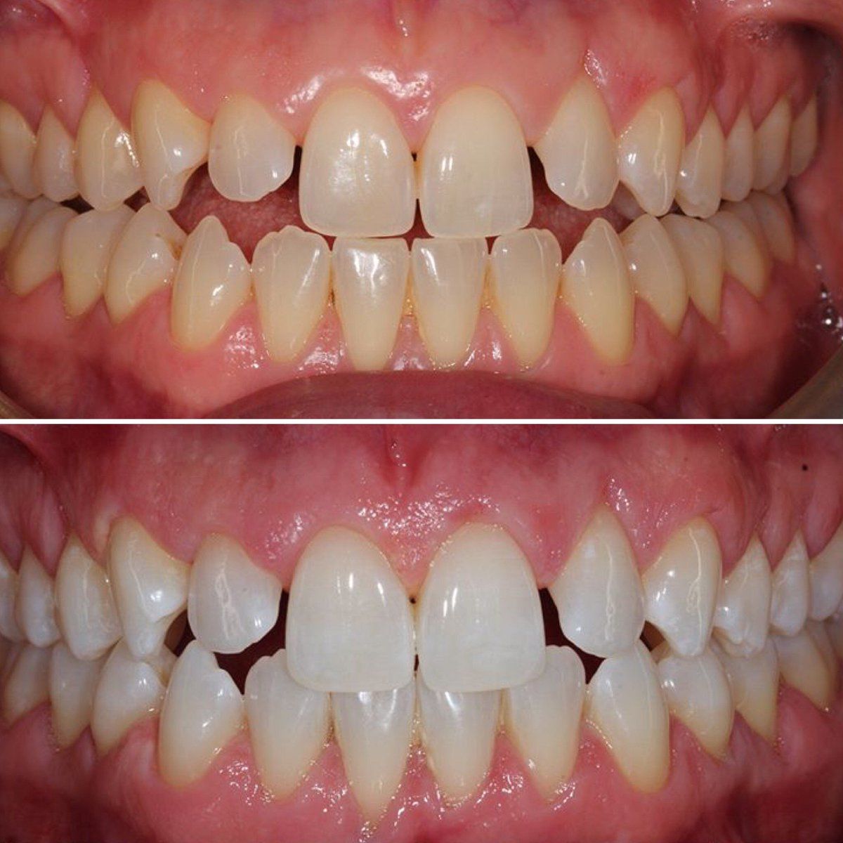 Customer photo review of Teeth Whitening Kit