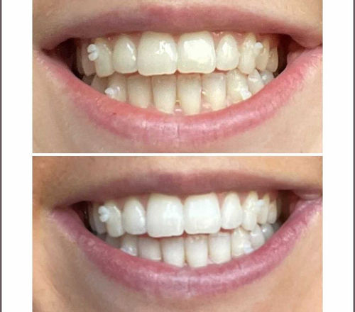 Customer photo review of Teeth Whitening Strips