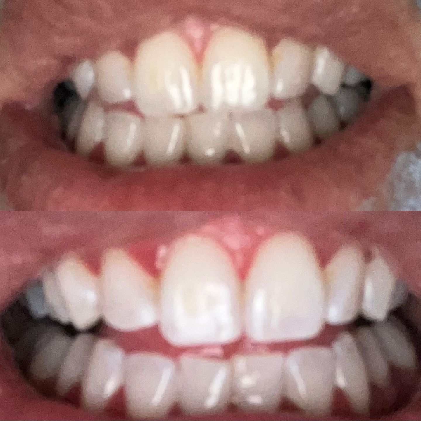 Customer photo review of Teeth Whitening Kit