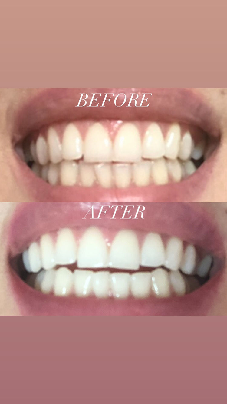 Customer photo review of Teeth Whitening Kit