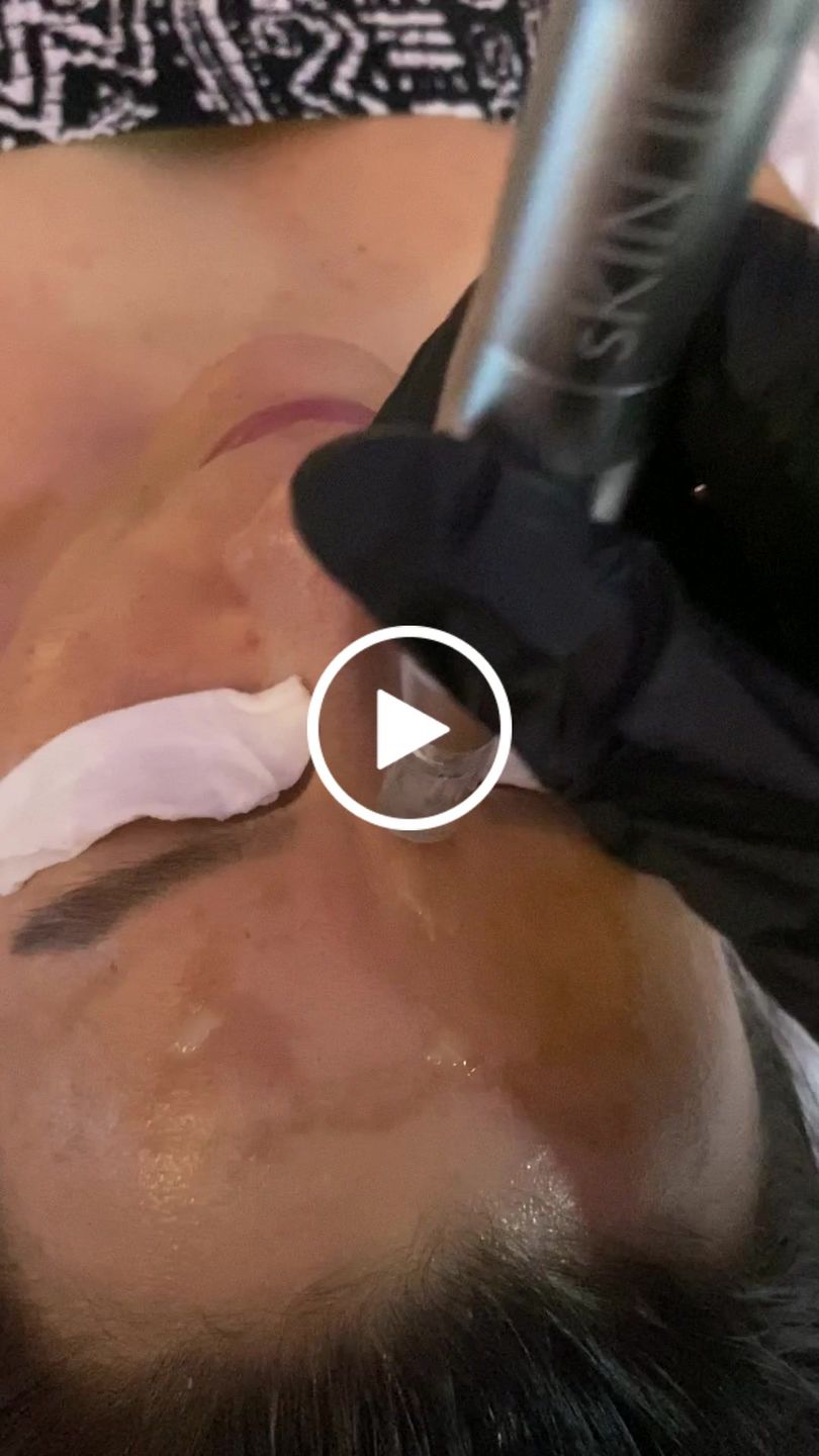 Customer video review of Reset Skin System Dermal Needling Device