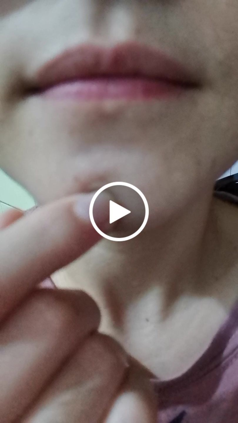 Customer video review of SOME BY MI 30 Days Miracle Clear Spot Patch (18 parches)