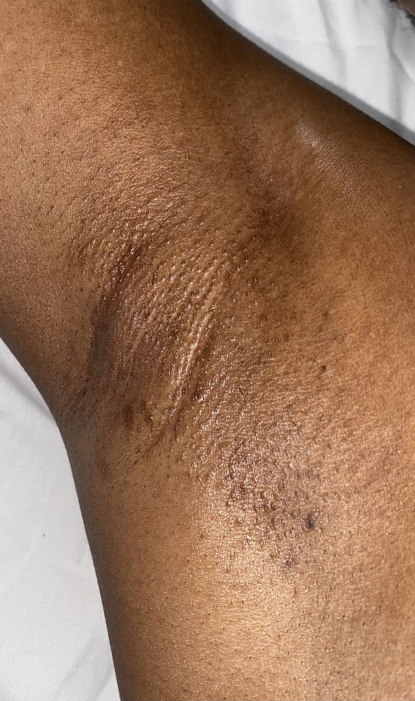 Customer photo review of Pomegranate Hypoallergenic Hard Wax