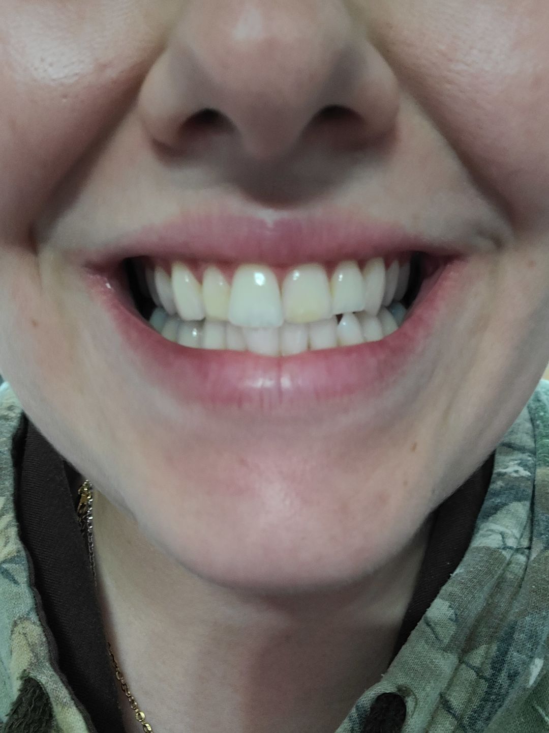 Customer photo review of Bandes Blanchissantes PAP (sans peroxyde)