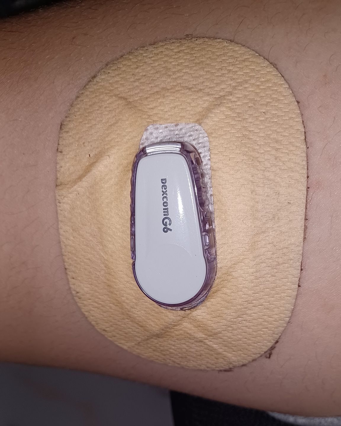 Customer photo review of Skin Grip MAX Dexcom G6 Patches