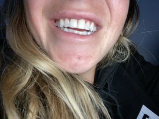 Customer photo review of Bandes Blanchissantes PAP (sans peroxyde)