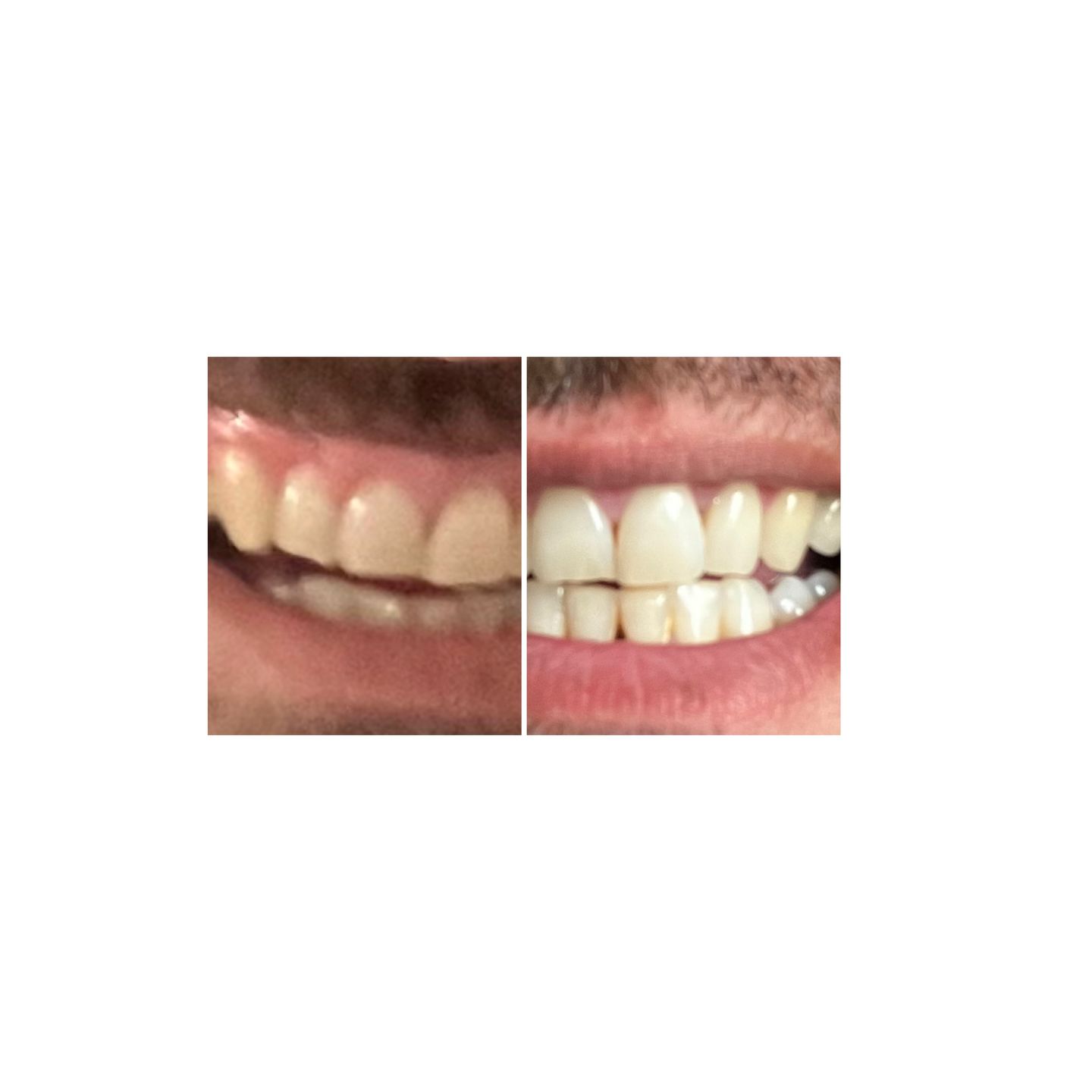 Customer photo review of Teeth Whitening Strips