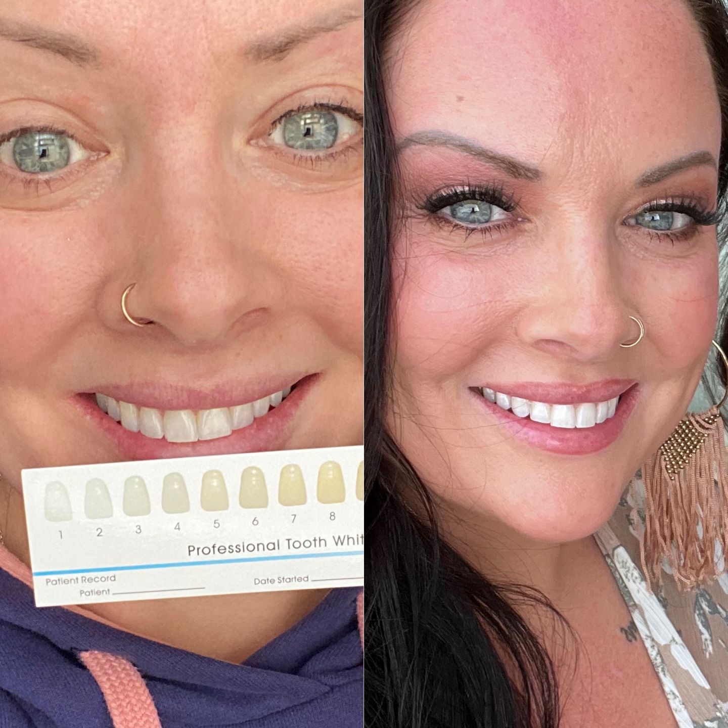 Customer photo review of ETERNAL TEETH WHITENING KIT