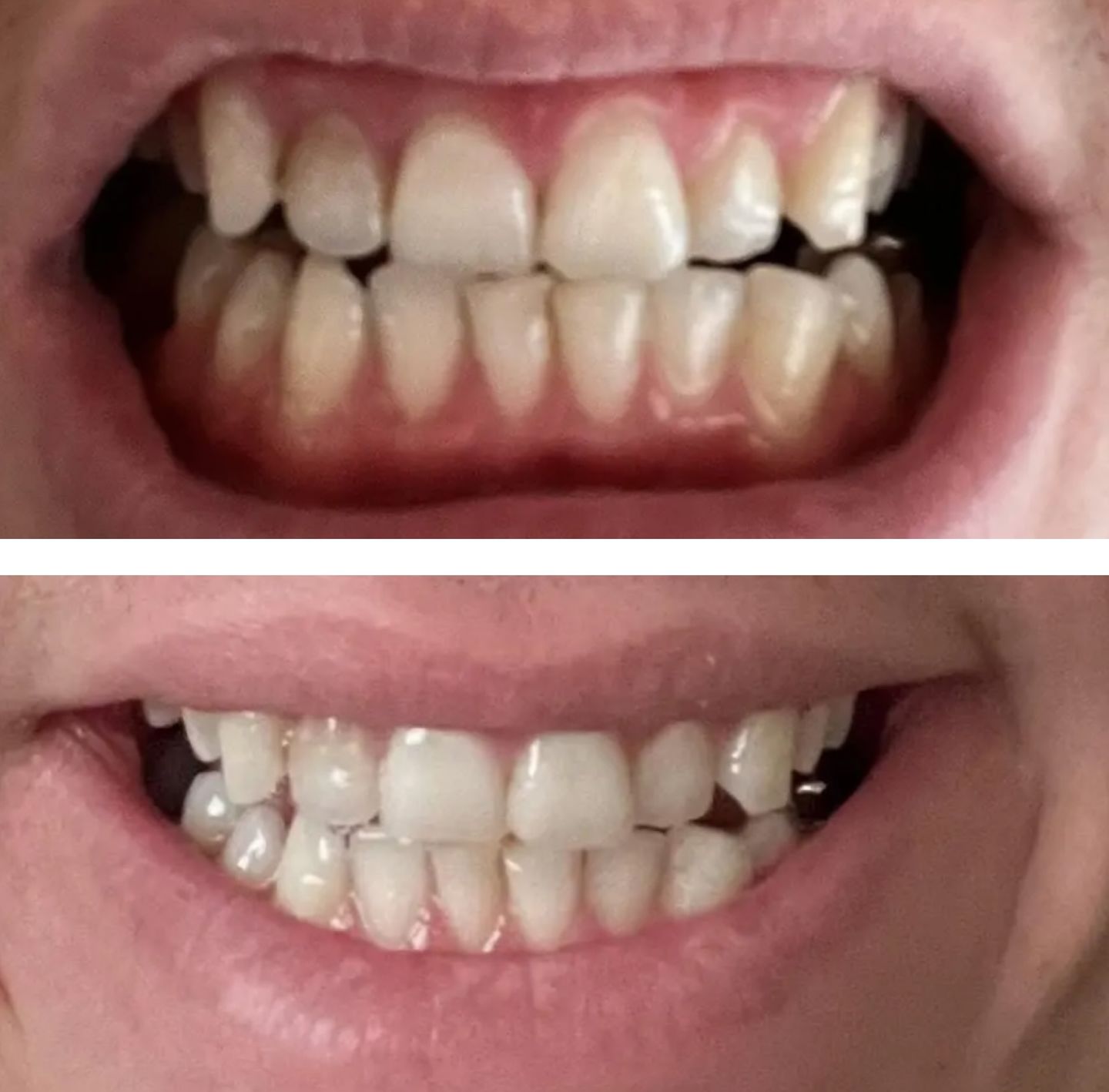 Customer photo review of Teeth Whitening Strips