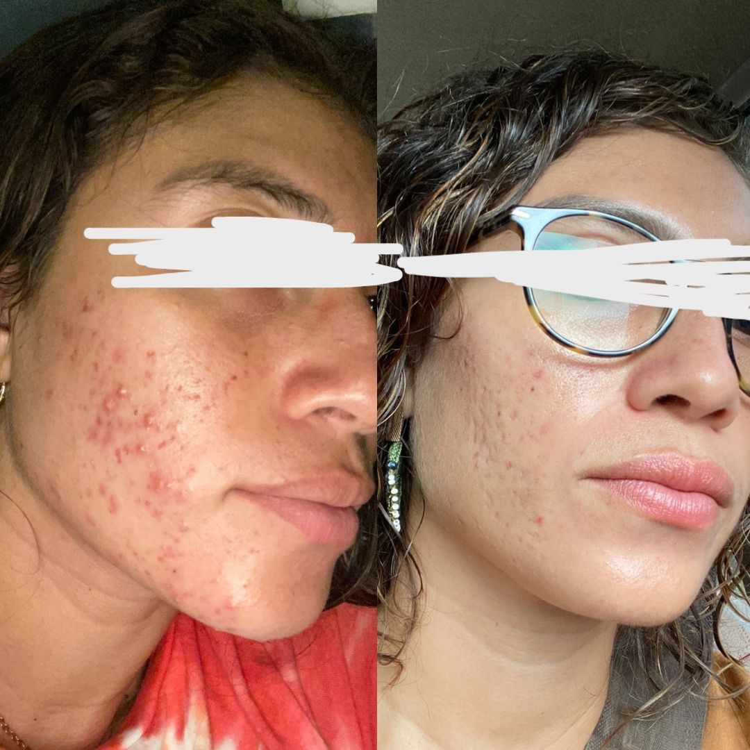 Customer photo review of Differin Gel Adapalene Gel 0.1% Acne Treatment 15g