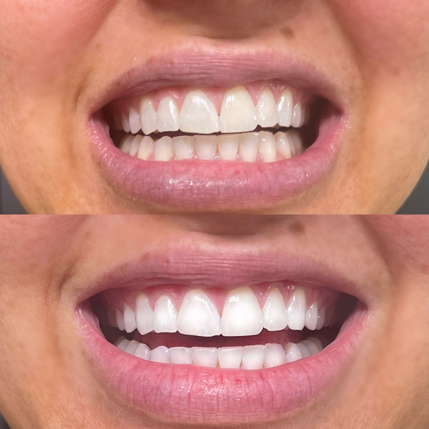 Customer photo review of ETERNAL TEETH WHITENING KIT