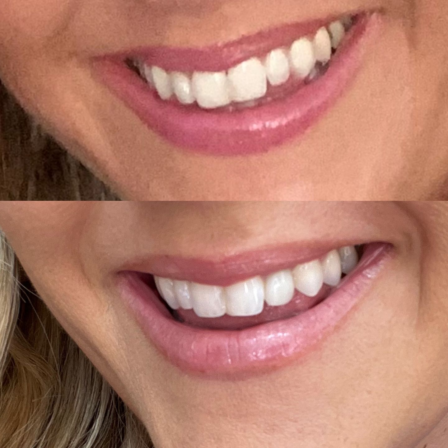 Customer photo review of ETERNAL TEETH WHITENING KIT