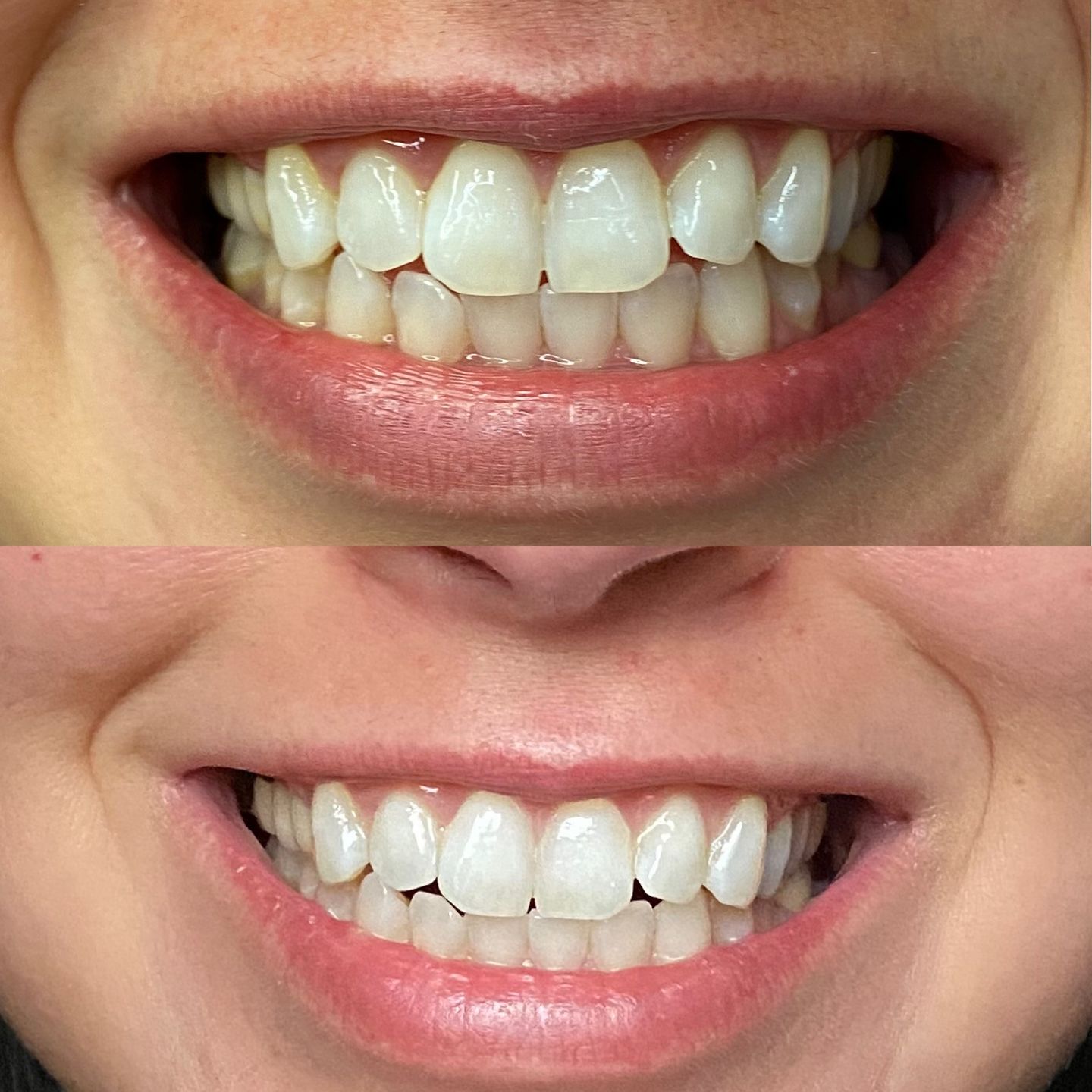 Customer photo review of ETERNAL TEETH WHITENING KIT