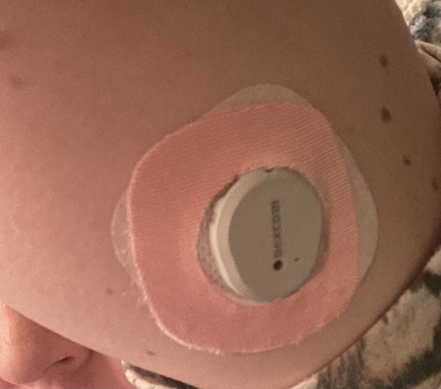 Customer photo review of Skin Grip Original - Dexcom G7 Adhesive Patches (With Hole)