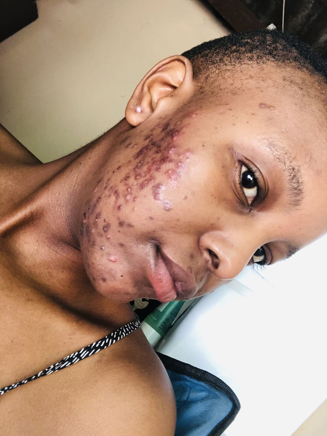 Customer photo review of Gmaeum Clear Complexion Set