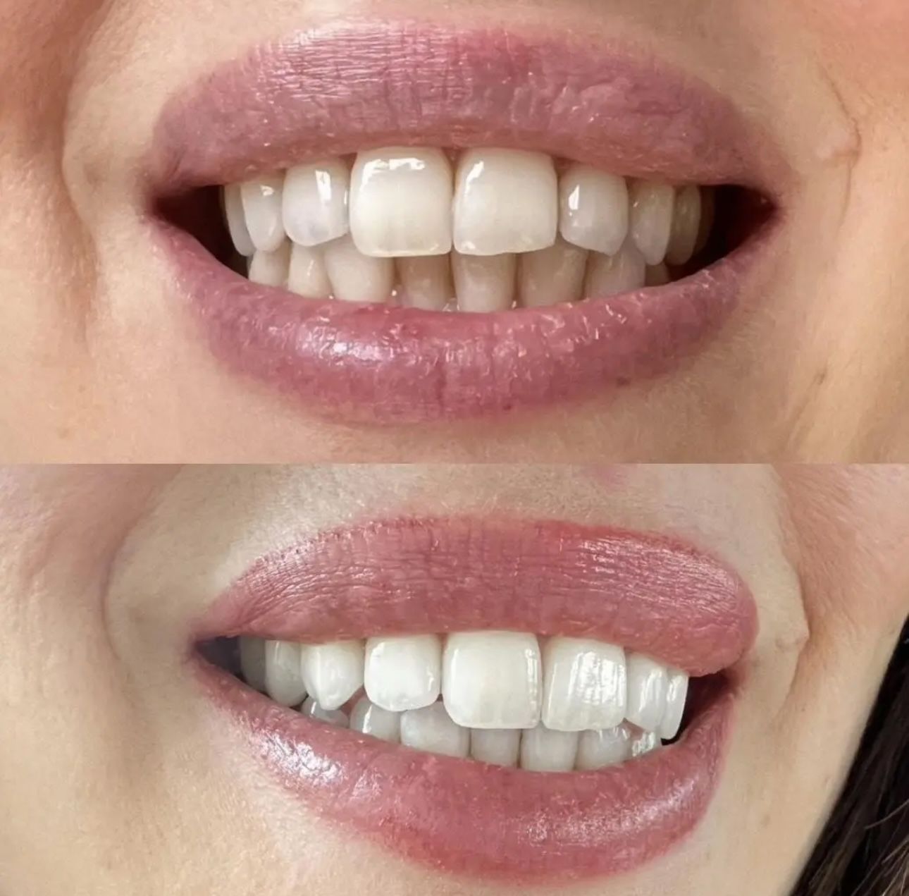 Customer photo review of Teeth Whitening Strips