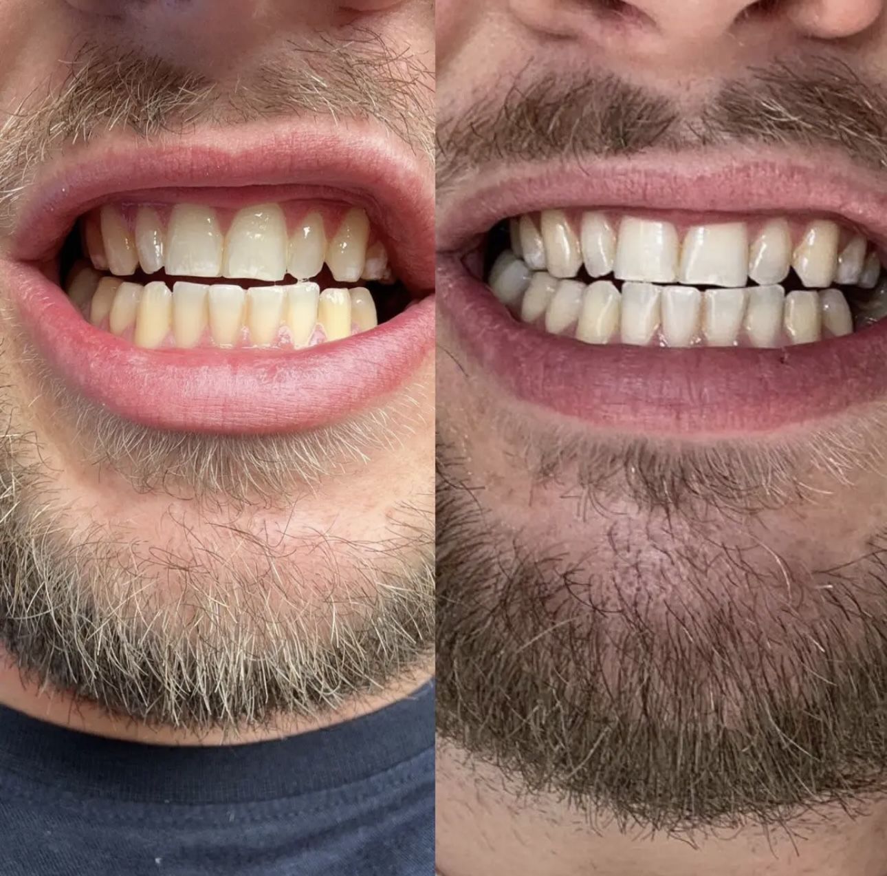 Customer photo review of Teeth Whitening Strips