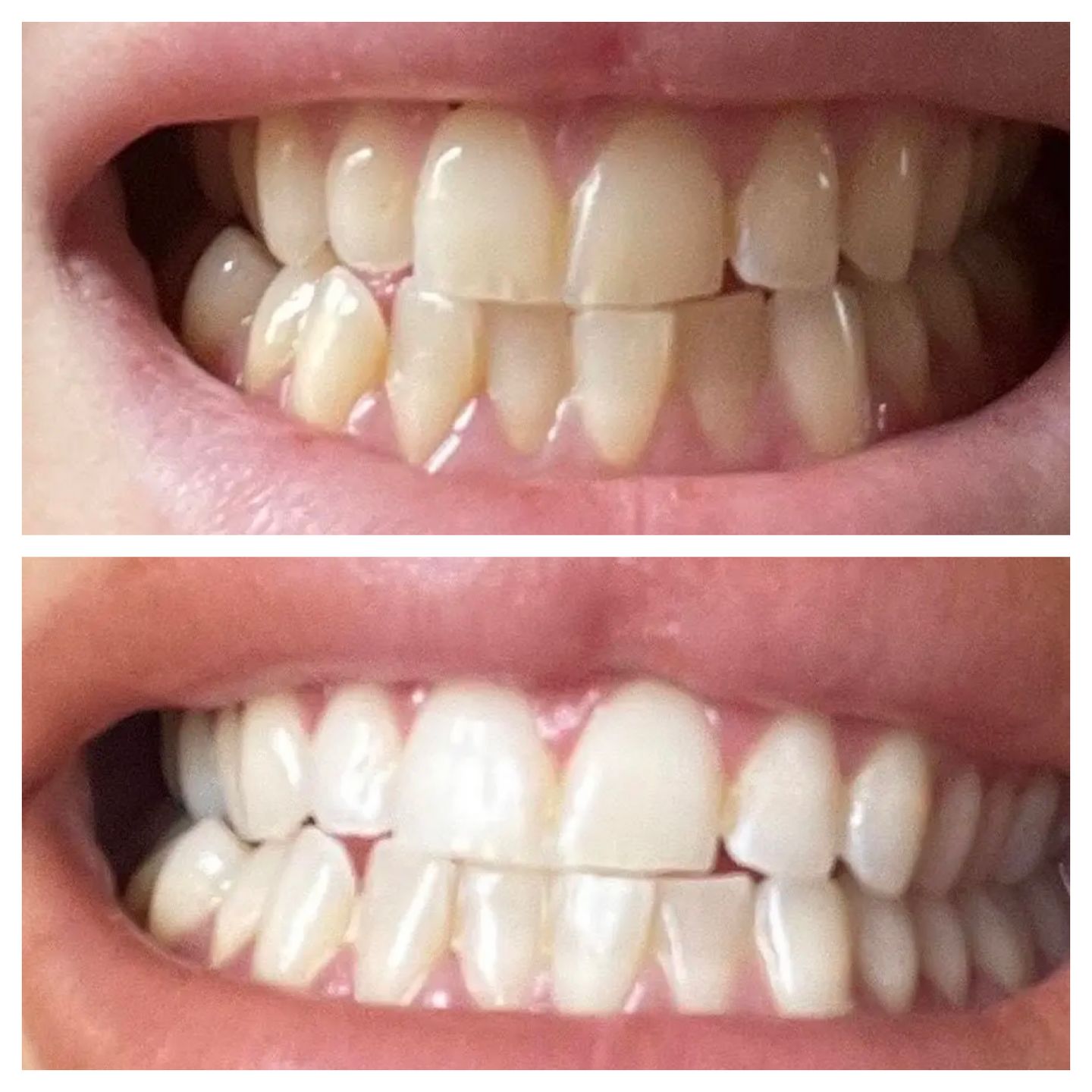 Customer photo review of Teeth Whitening Strips