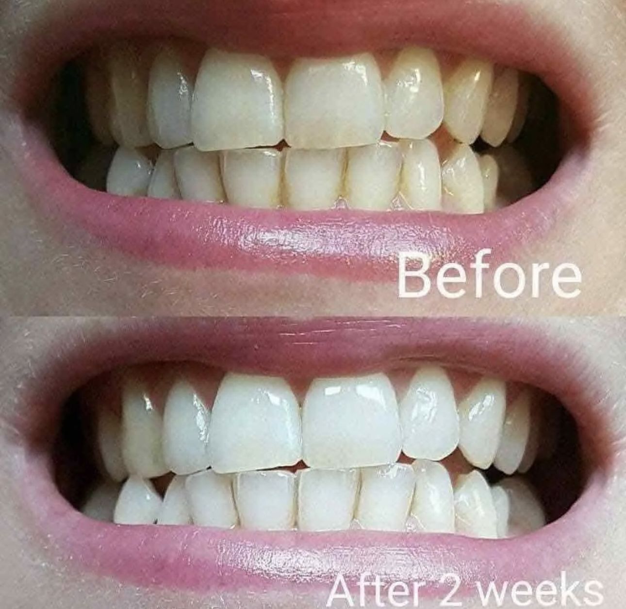 Customer photo review of Teeth Whitening Strips