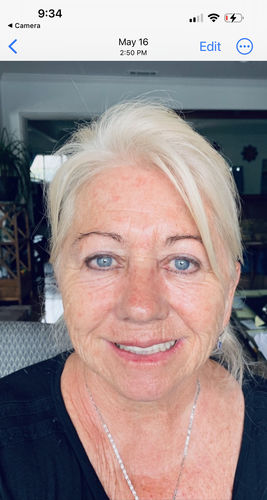 Customer photo review of EvenSkyn® Lumo: Premium Anti-Aging & Skin Tightening Handset