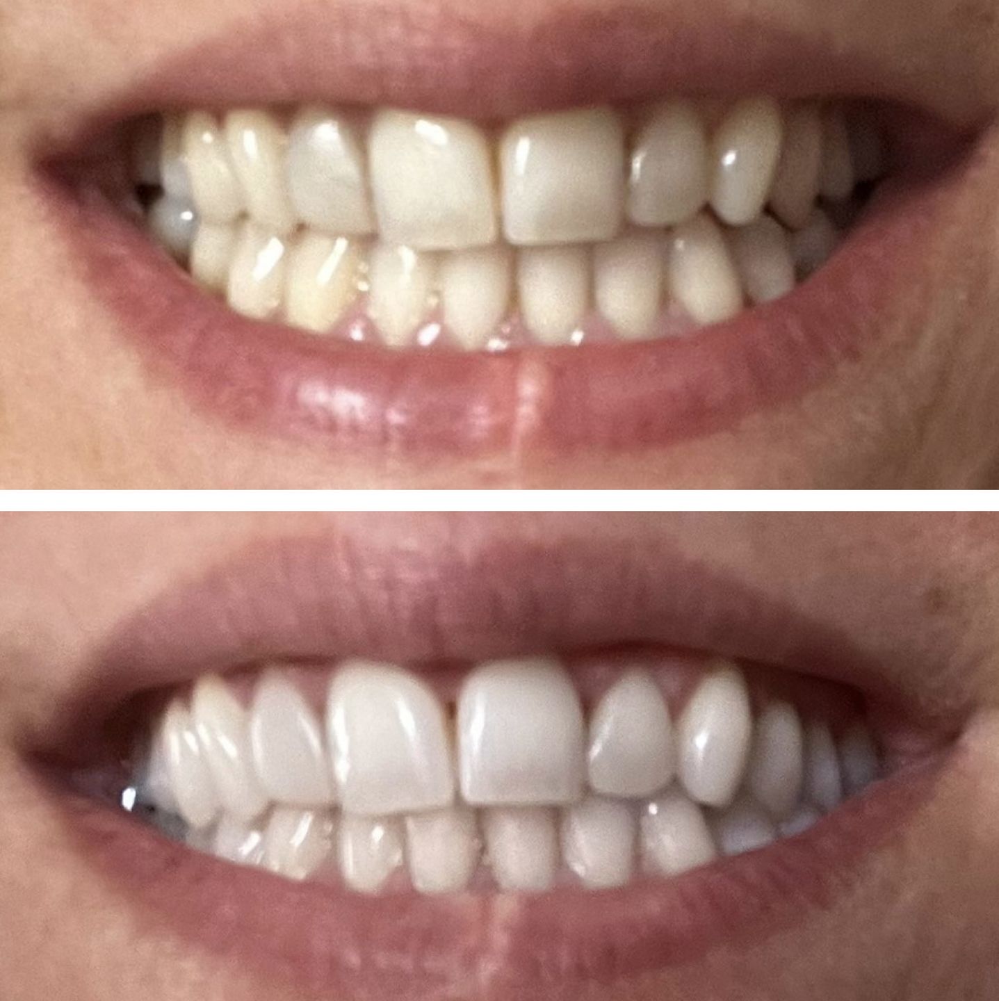 Customer photo review of Teeth Whitening Strips