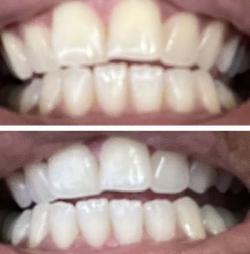 Customer photo review of Teeth Whitening Strips
