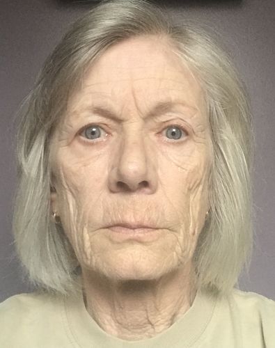 Customer photo review of EvenSkyn® Lumo: Premium Anti-Aging & Skin Tightening Handset