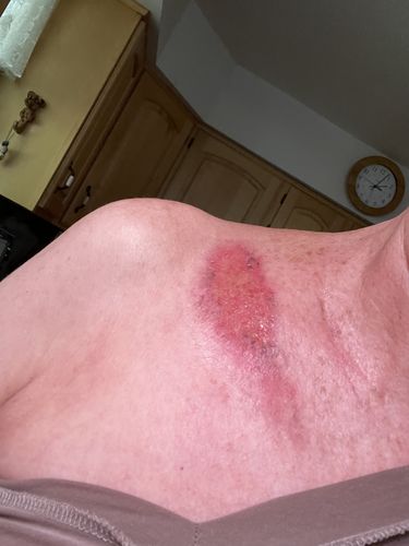 Customer photo review of Radiation Burn Cream for Radiation Therapy Patients