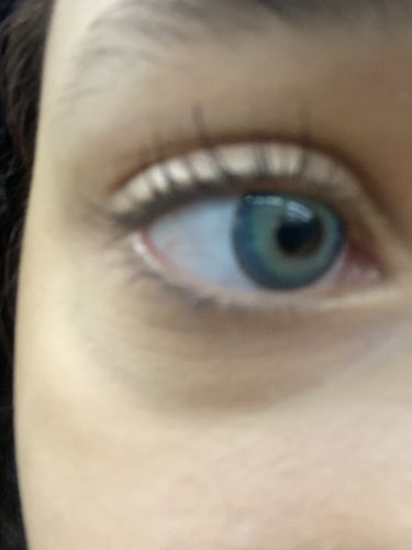 Customer photo review of Himalaya Blue Contact Lenses(12 months of use)