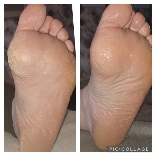 Customer photo review of LOVASKIN FEET COCOONING - Instant Foot Peel 75 ml with Instant Moisturizer 50 ml