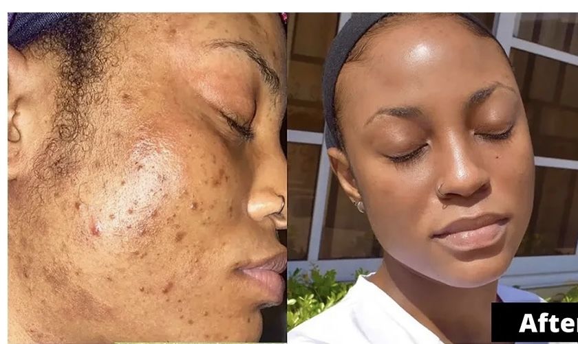 Customer photo review of 24k Golden Glow Essential Acne Kit