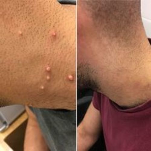 Customer photo review of CC™ Tags & Moles Remover