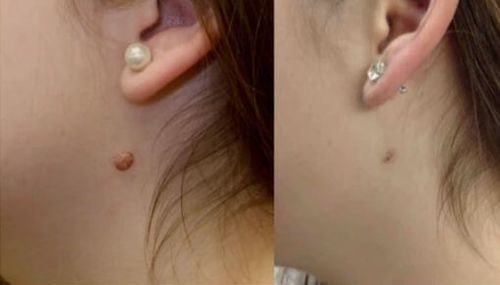 Customer photo review of CC™ Instant Tags & Moles Removal Gel