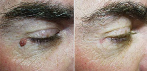 Customer photo review of CC™ Instant Tags & Moles Removal Gel